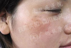 广州肤康皮肤病医院